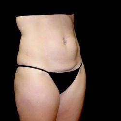 Tummy Tuck Before & After Patient #22610