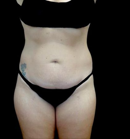 Tummy Tuck Before & After Patient #22584