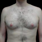 Gynecomastia Before & After Patient #22629