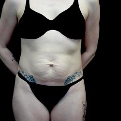 Tummy Tuck Before & After Patient #22641