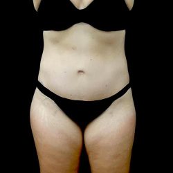 Tummy Tuck Before & After Patient #22584