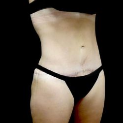 Tummy Tuck Before & After Patient #22610