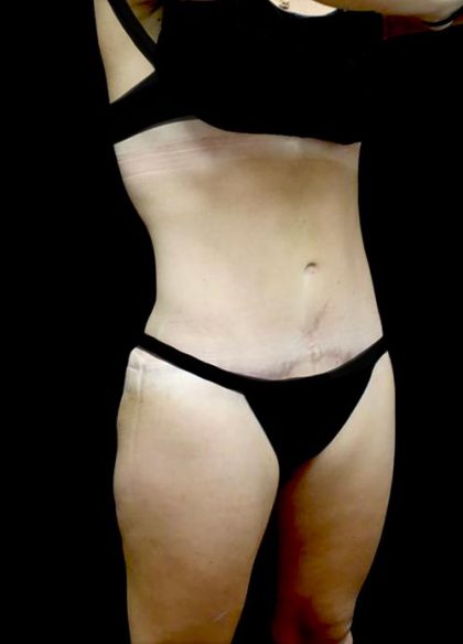 Tummy Tuck Before & After Patient #22610