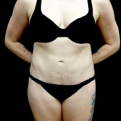 Tummy Tuck Before & After Patient #22641