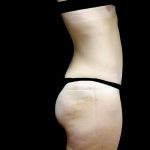 Tummy Tuck Before & After Patient #22610