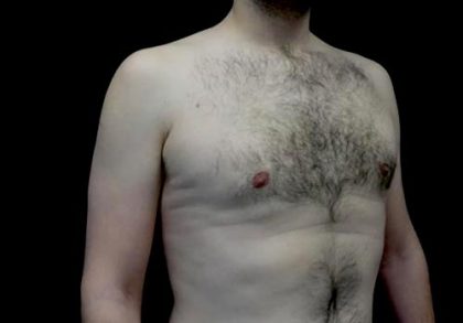Gynecomastia Before & After Patient #22629