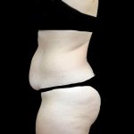 Tummy Tuck Before & After Patient #22584