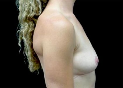 Breast Lift Before & After Patient #22603