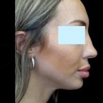 Restylane Before & After Patient #22622