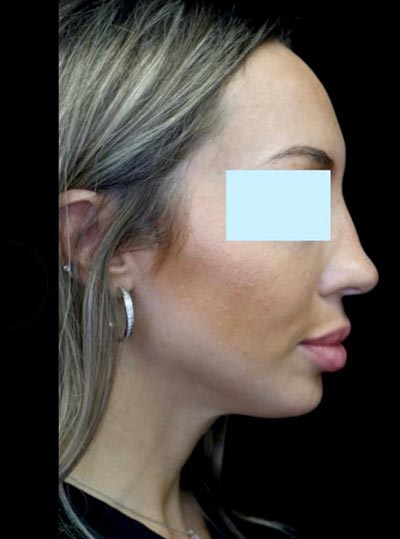Restylane Before & After Patient #22622
