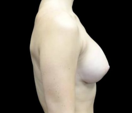 Breast Augmentation (Implants) Before & After Patient #22731