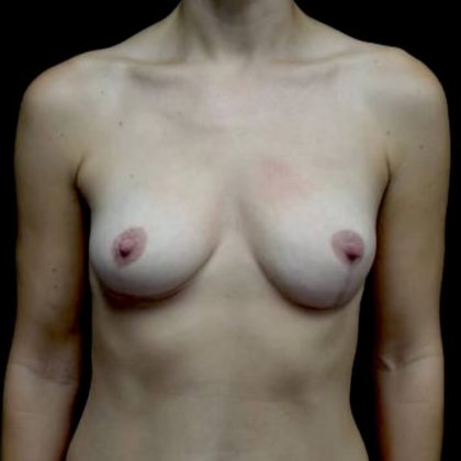 Breast Lift Before & After Patient #22747