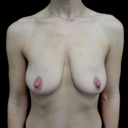 Breast Lift Before & After Patient #22747