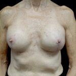 Breast Lift Before & After Patient #22715