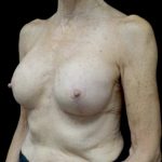 Breast Lift Before & After Patient #22715