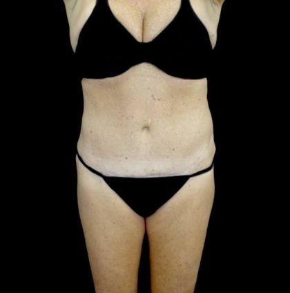 Tummy Tuck Before & After Patient #22722