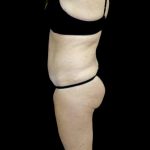 Tummy Tuck Before & After Patient #22722