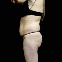 Tummy Tuck Before & After Patient #22722