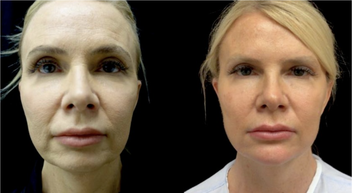 Fillers & Injectables Case #22366