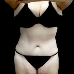 Tummy Tuck Before & After Patient #22738