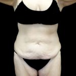 Tummy Tuck Before & After Patient #22738