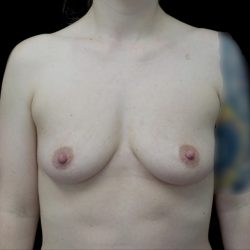 Breast Augmentation (Fat Transfer) Before & After Patient #22945
