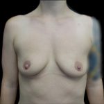 Breast Augmentation (Fat Transfer) Before & After Patient #22945