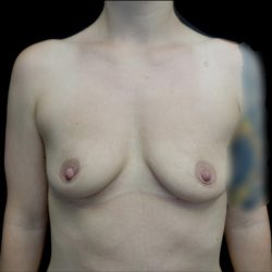 Breast Augmentation (Fat Transfer) Before & After Patient #22945