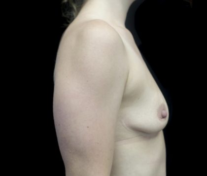 Breast Augmentation (Fat Transfer) Before & After Patient #22945