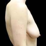Breast Lift with Implants Before & After Patient #23097