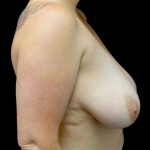 Breast Implant Removal (Explant Surgery) Before & After Patient #23110