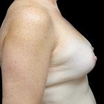 Breast Lift with Implants Before & After Patient #23089