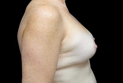 Breast Lift with Implants Before & After Patient #23089