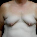 Breast Lift with Implants Before & After Patient #23089