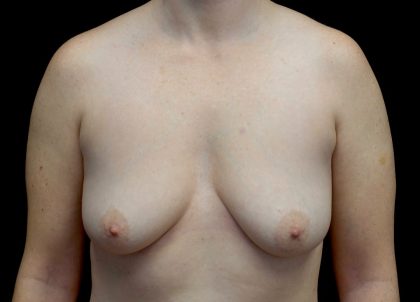 Breast Augmentation (Implants) Before & After Patient #23081