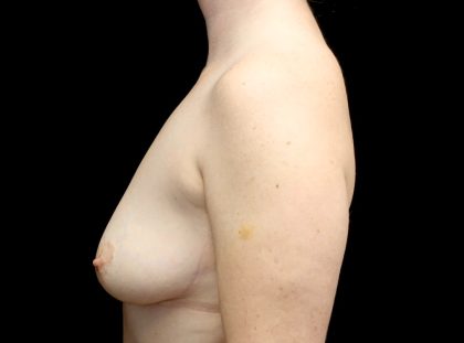 Breast Augmentation (Implants) Before & After Patient #23081