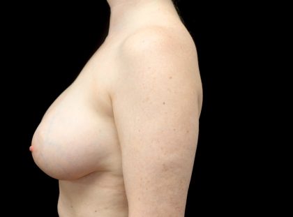 Breast Augmentation (Implants) Before & After Patient #23081