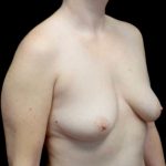 Breast Augmentation (Implants) Before & After Patient #23081