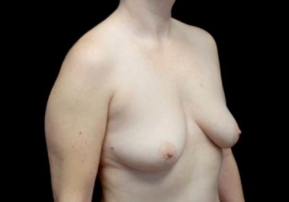 Breast Augmentation (Implants) Before & After Patient #23081