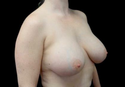 Breast Augmentation (Implants) Before & After Patient #23081