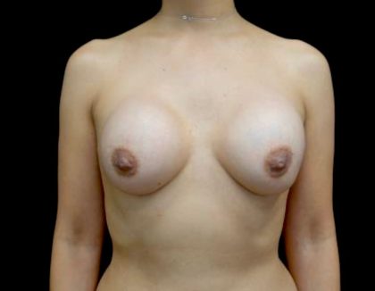 Breast Augmentation (Fat Transfer) Before & After Patient #23071