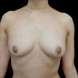 Breast Augmentation (Fat Transfer) Before & After Patient #23071