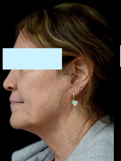 Intensive Pulse Light (IPL) Before & After Patient #23061