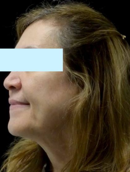 Intensive Pulse Light (IPL) Before & After Patient #23061