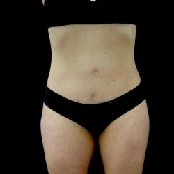 Tummy Tuck Before & After Patient #23049