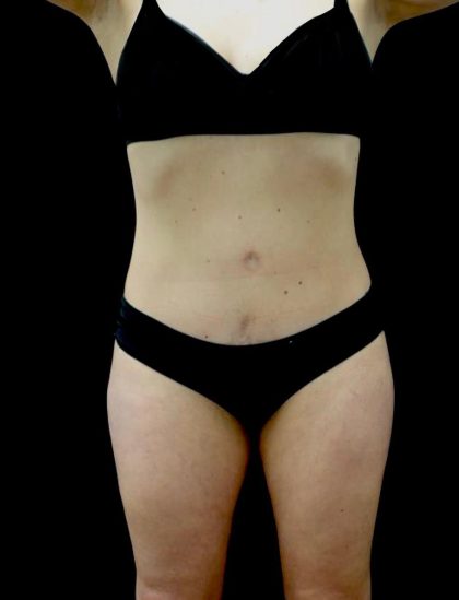 Tummy Tuck Before & After Patient #23049