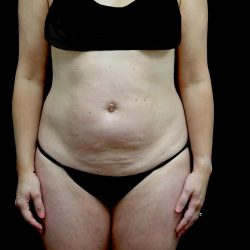 Tummy Tuck Before & After Patient #23049