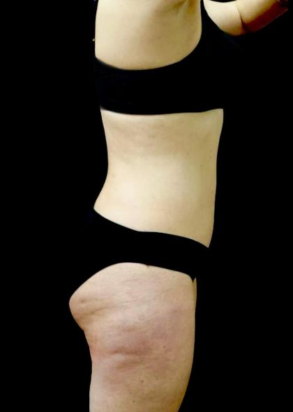 Tummy Tuck Before & After Patient #23049