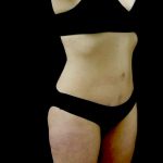 Tummy Tuck Before & After Patient #23049