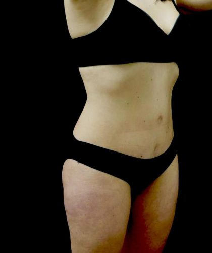 Tummy Tuck Before & After Patient #23049